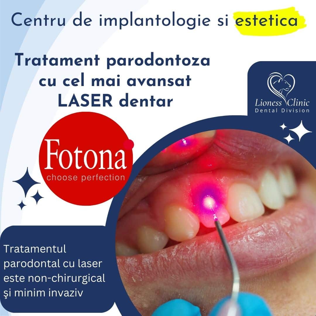 Tratament parodontoza cu laser
